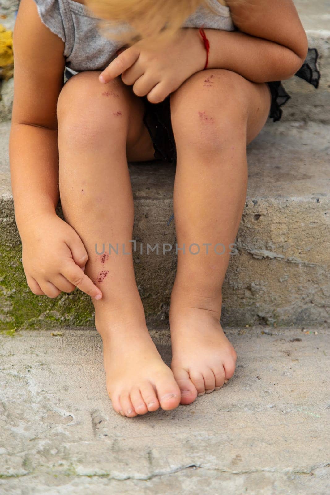 A child has a scratch on his leg. Selective focus. by yanadjana