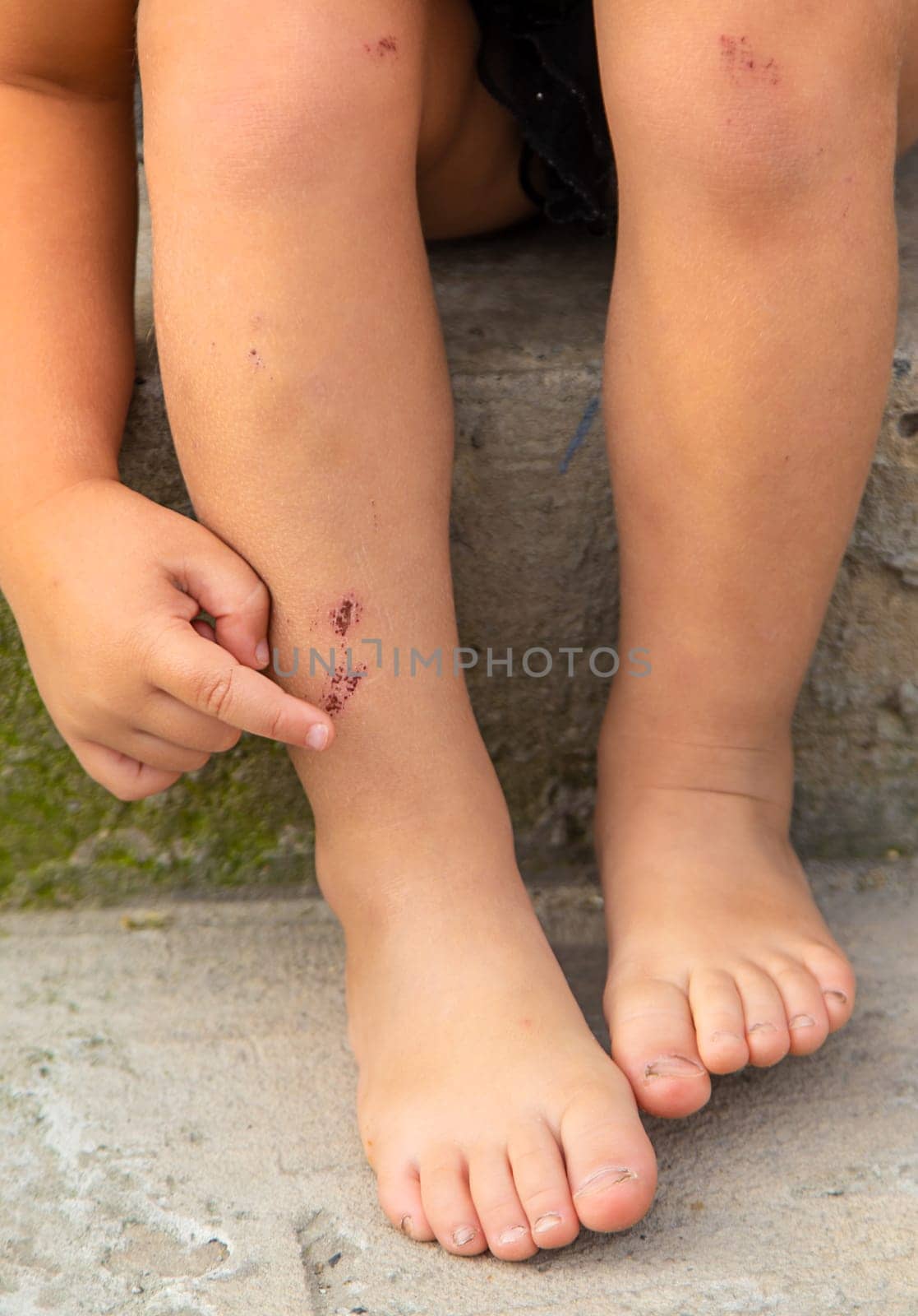 A child has a scratch on his leg. Selective focus. Kid.