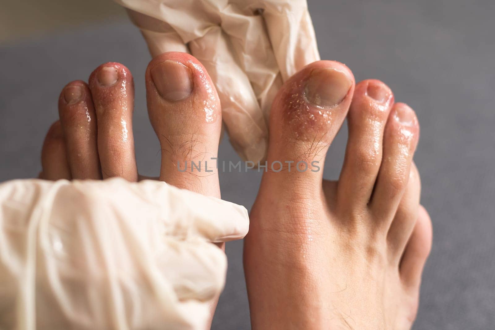 covid toes, bites on a man's toes