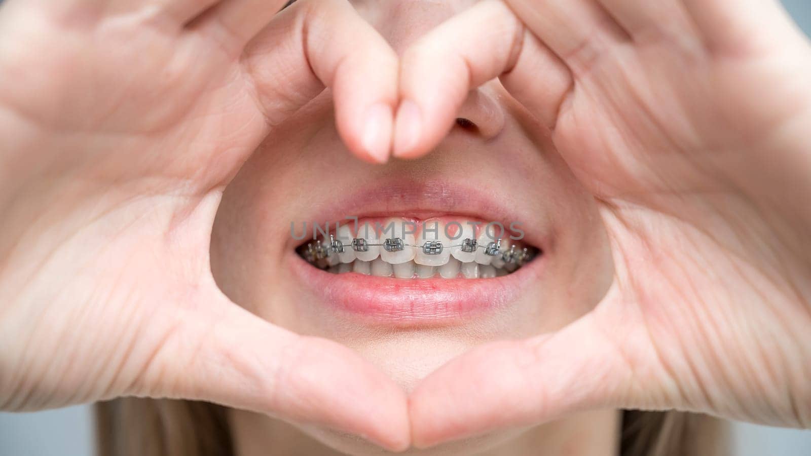 Caucasian woman in braces holding fingers in the shape of a heart. by mrwed54