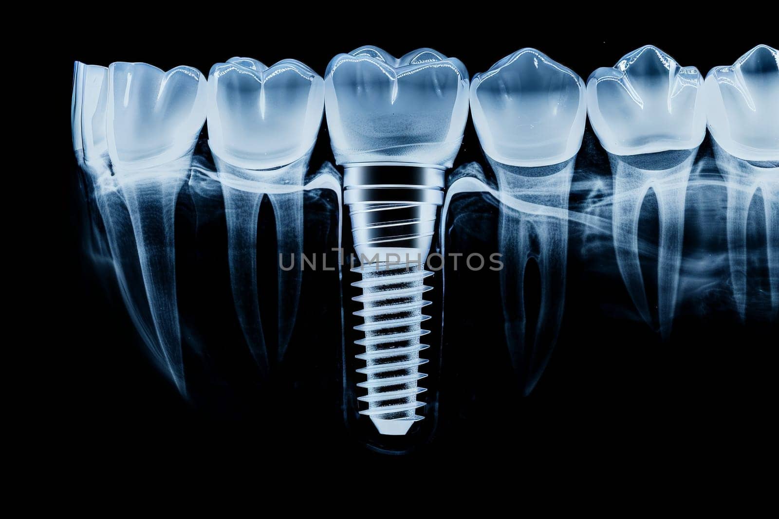 dental implant placement. An X-ray image displaying a dental implant anchored in the jawbone. . Generative Ai.