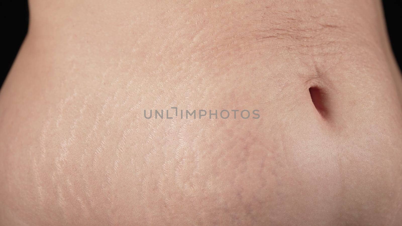Woman showing stretch marks on abdomen after pregnancy. Natural body texture. Mothers belly with heavy wrinkles,loose skin after birth child.Health care,rehabilitation,body positive,accepting