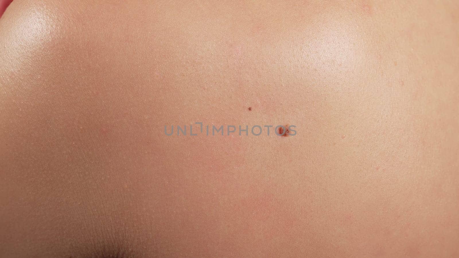 Human papillomavirus. Female back covered with nevuses. Birthmark of Papiloma neoplasm on human skin, growth close-up. Health care concept.