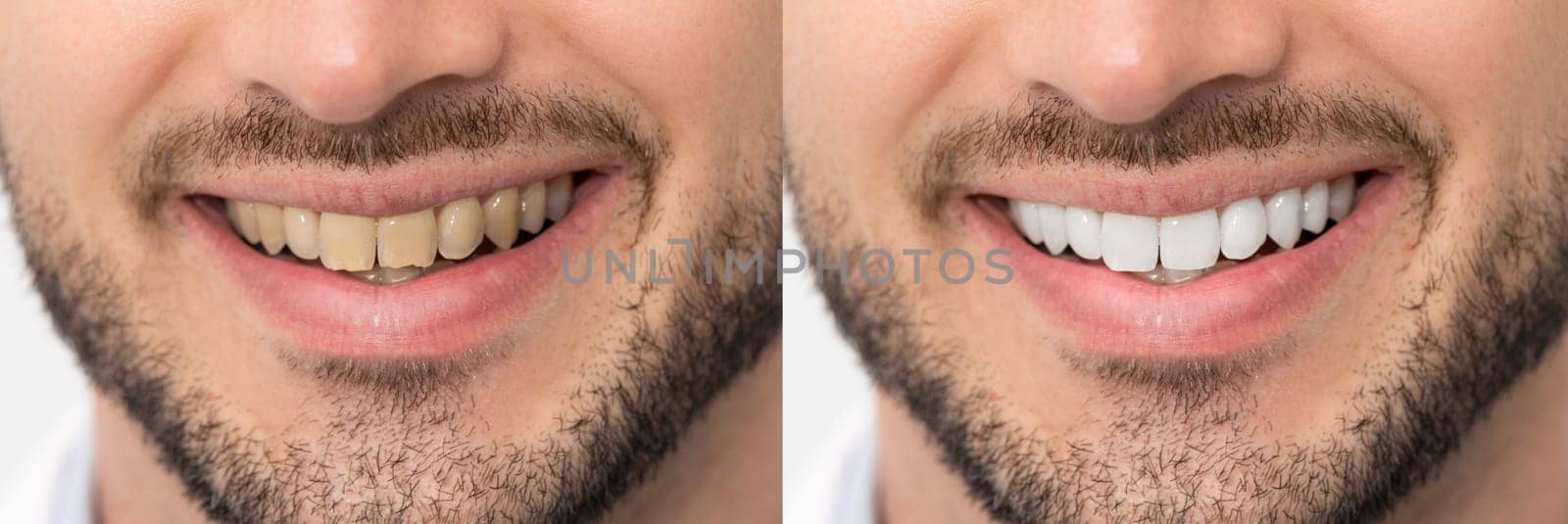 Teeth before and after whitening by simpson33