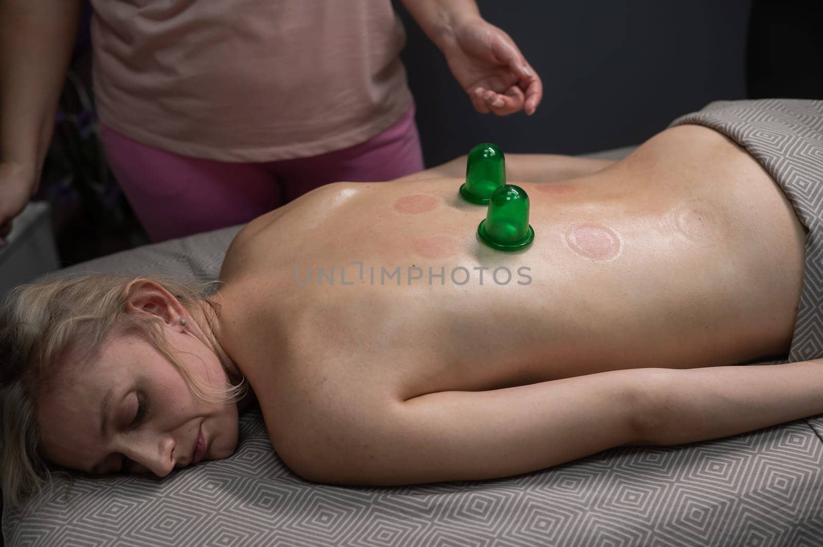 A woman undergoing a massage using vacuum plastic jars. by mrwed54