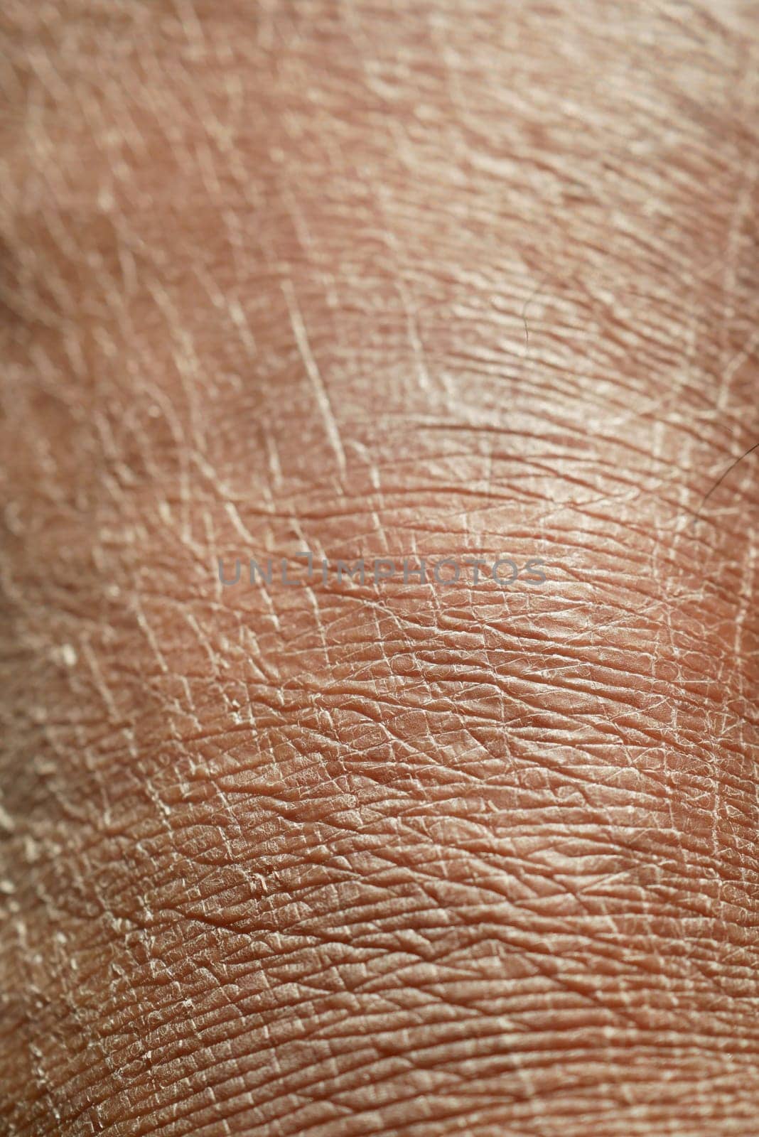 Closeup view of dry human skin