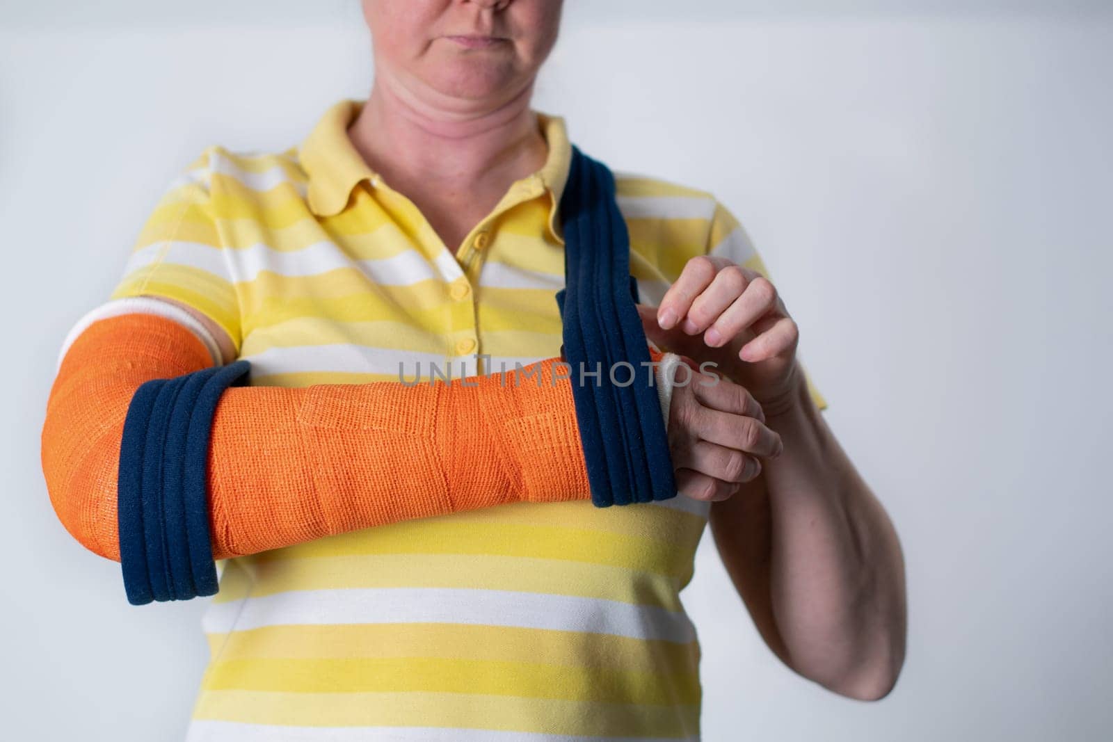 woman with a broken right arm wearing plaster casts to hold the broken bones in place until they heal, hanging her arm in a sling, modern treatments, High quality photo
