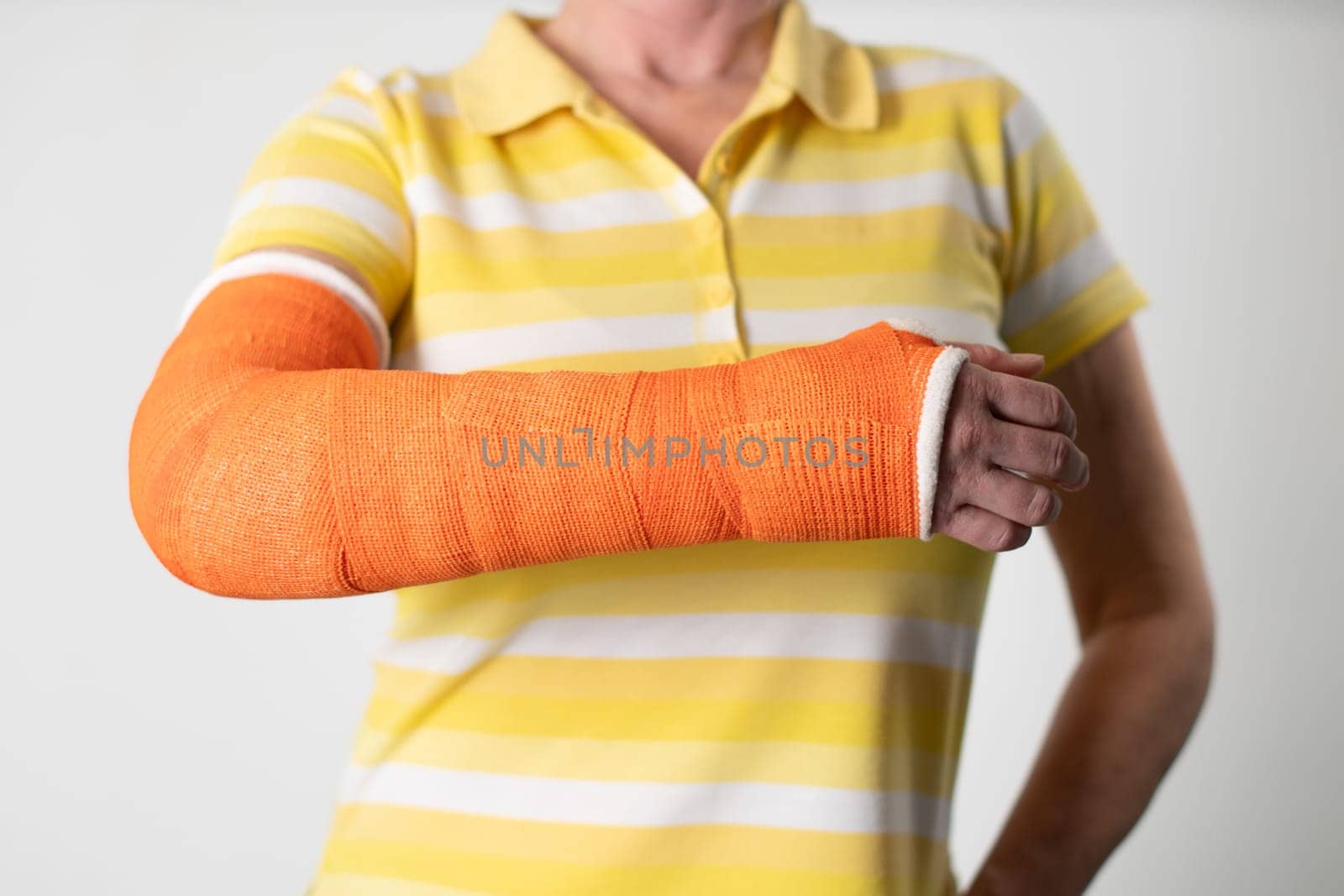 woman with a broken arm and an orange plaster plastic bandage on awhite background, modern materials for the treatment by KaterinaDalemans
