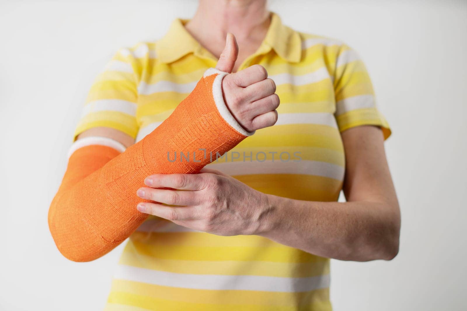 woman with a broken arm and an orange plaster plastic bandage on awhite background, modern materials for the treatment by KaterinaDalemans