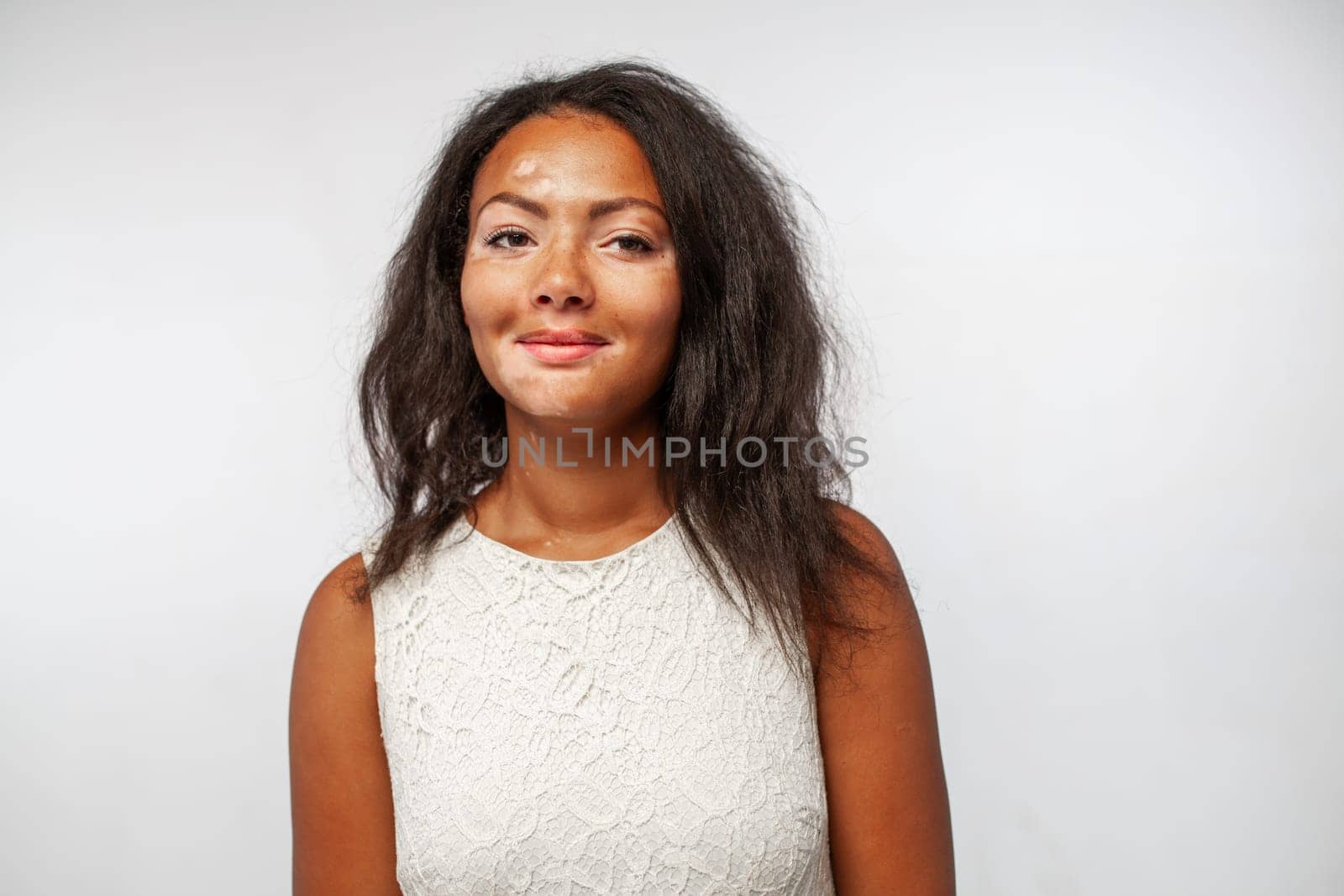 Happy black woman with skin problems Vitiligo disease looking at camera and smiling. Portrait of beautiful Arican lady standing on white background.