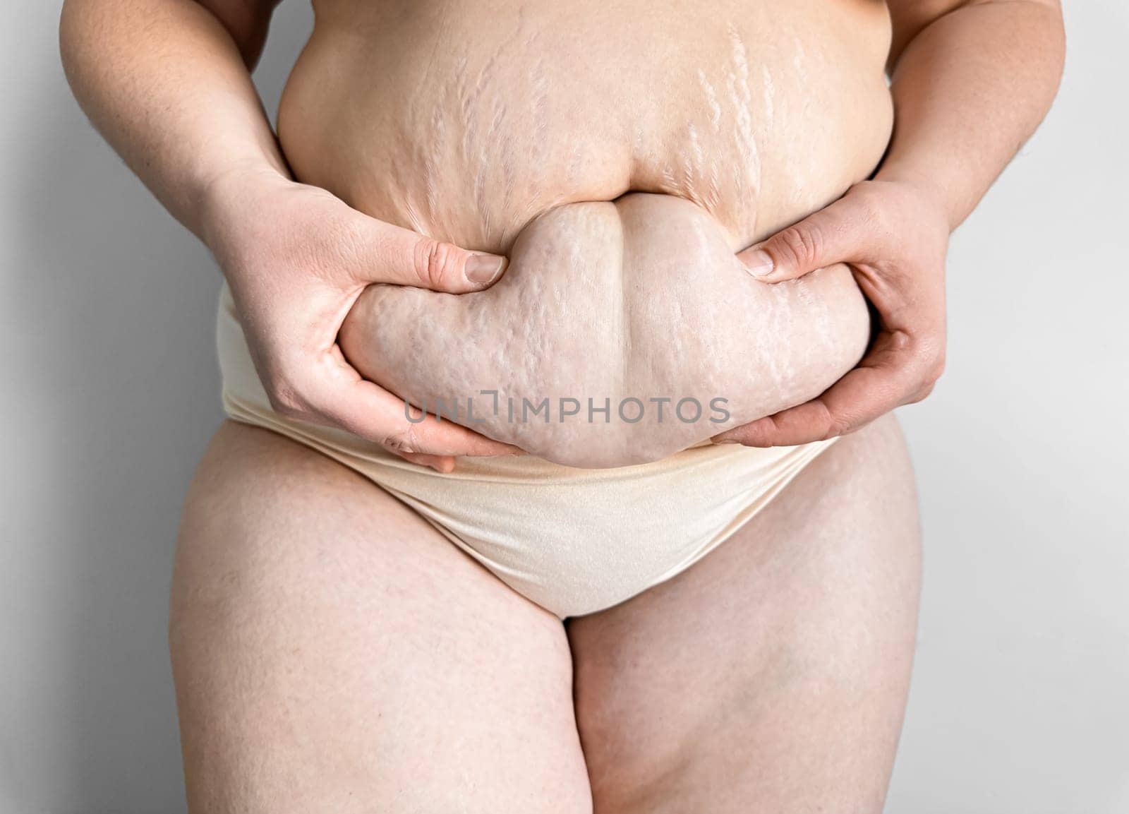 Close up of postpartum belly with stretch marks held by hands. Real womans body, motherhood changes, and self acceptance concept. High quality photo