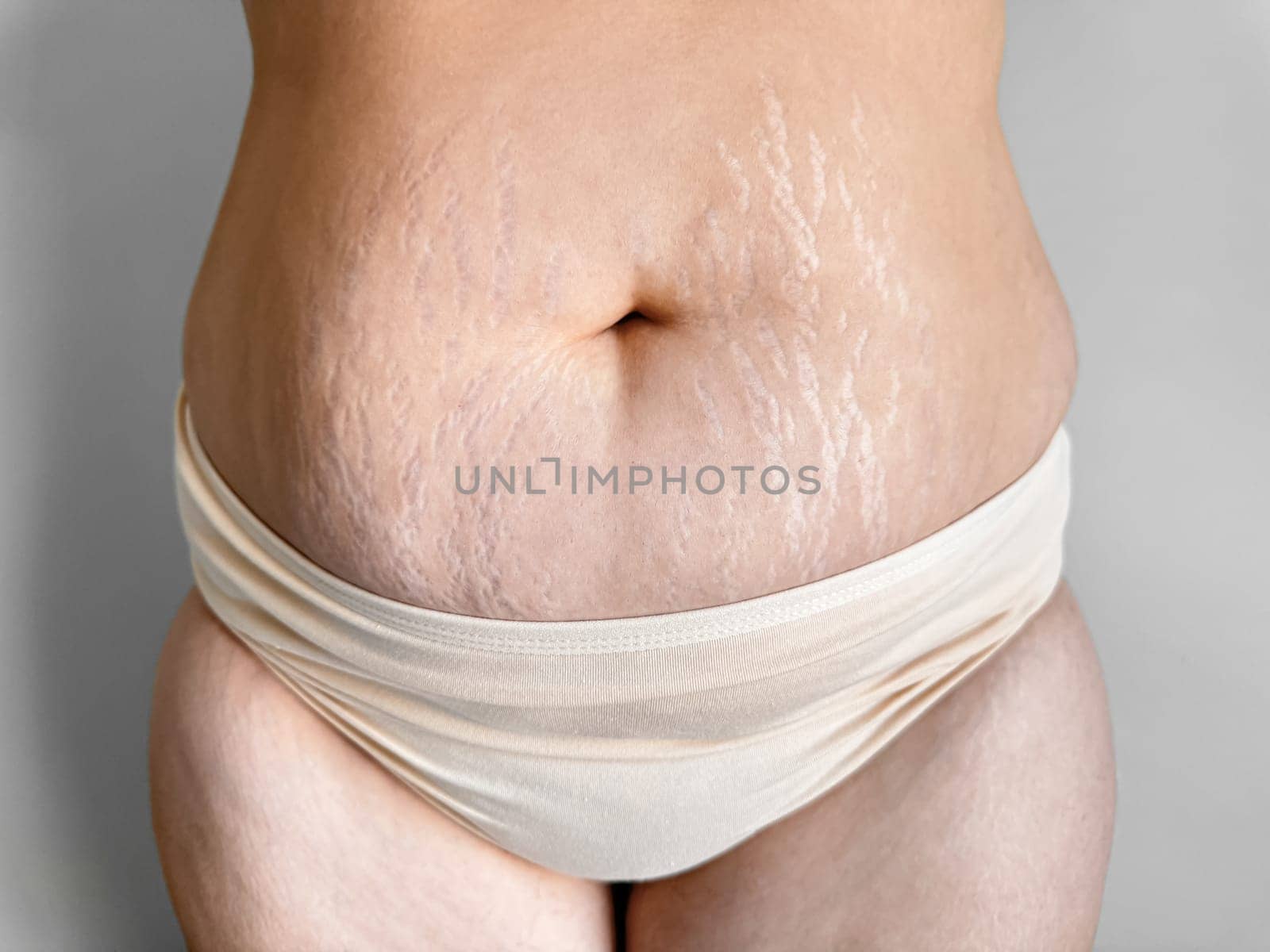 Womans midsection with stretch marks to celebrate real beauty, body positivity, and the natural changes after childbirth. The concept of self love and naturalness. High quality photo
