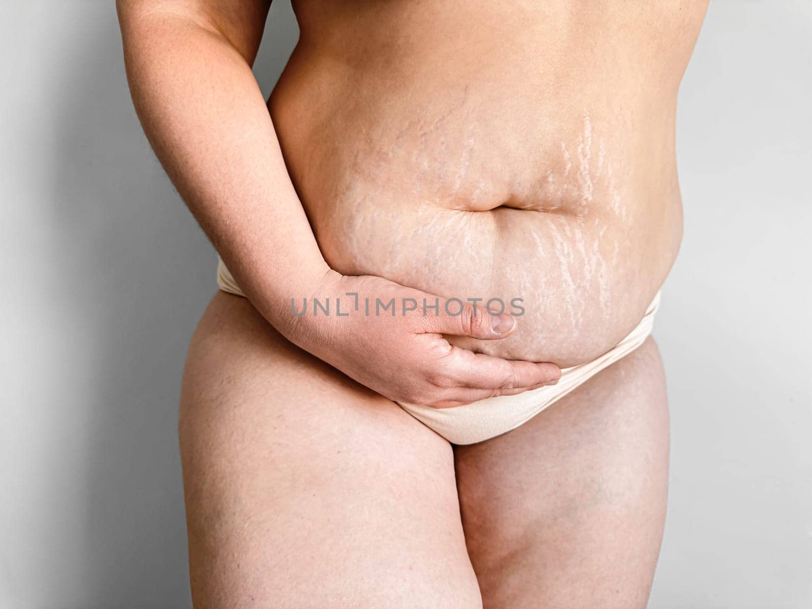 Postpartum womans midsection showing stretch marks, body positivity and real post pregnancy changes concept. by Lunnica