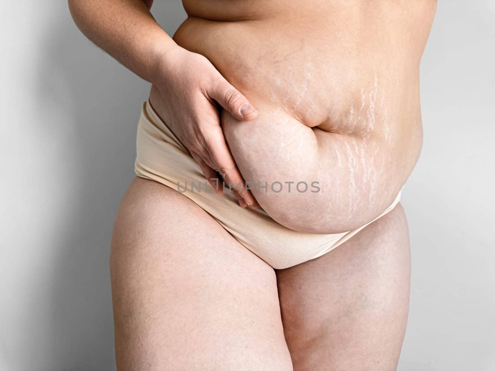 Postpartum womans midsection showing stretch marks, body positivity and real post pregnancy changes concept. by Lunnica