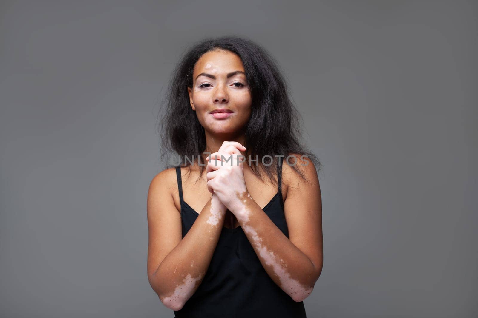 Beautiful happy African woman with Vitiligo disease looking at camera. Portrait of confident girl with hands clasped standing against gray background.