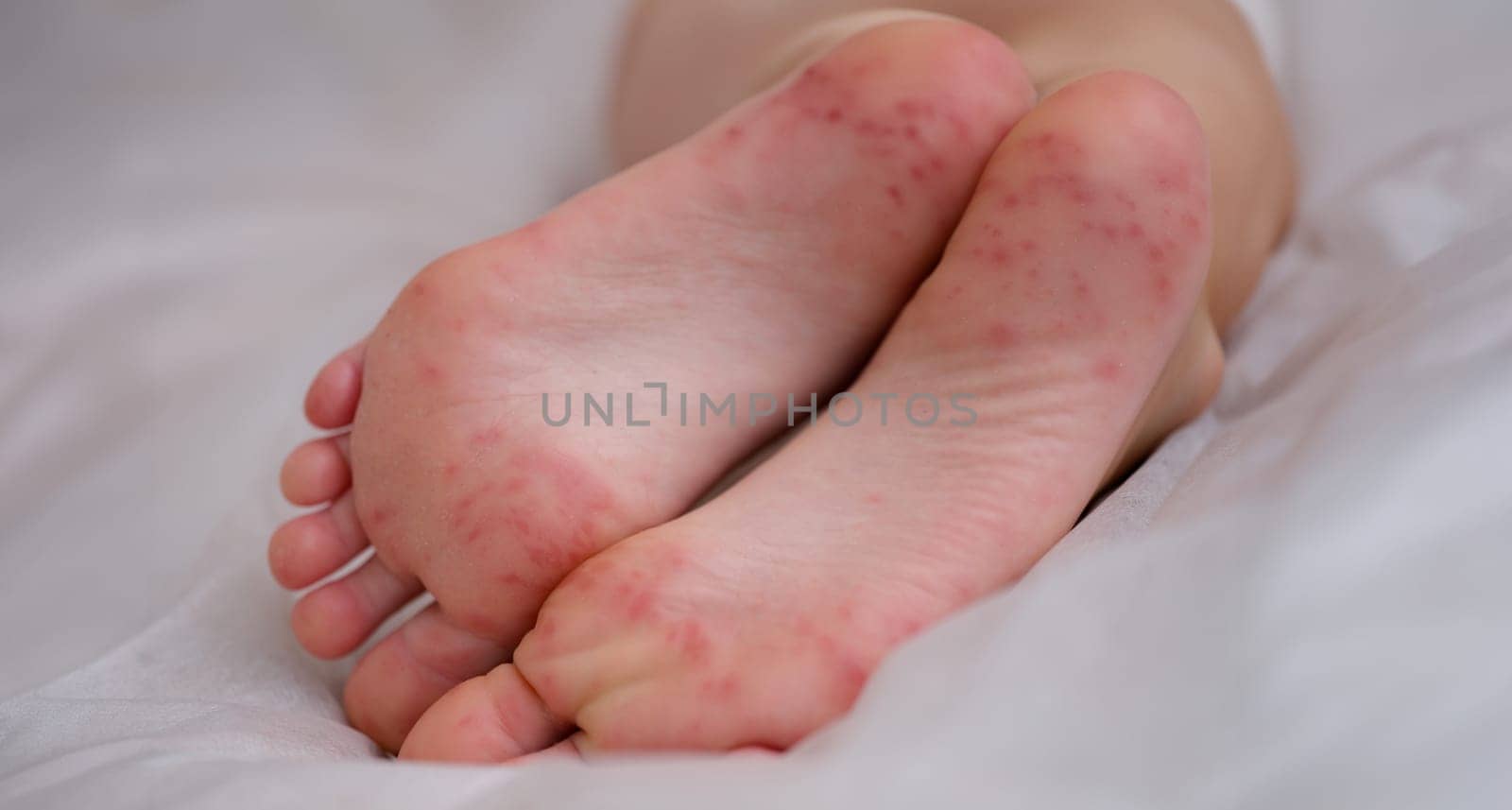 Painful rash red spots blisters on child leg by kuprevich