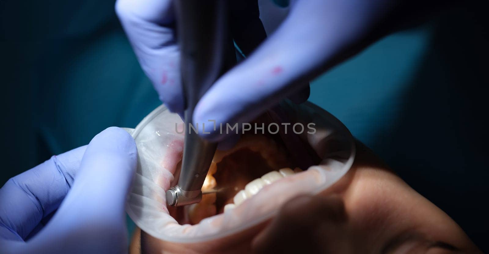 Dentist drills tooth to patient in dental chair. Dental caries treatment concept