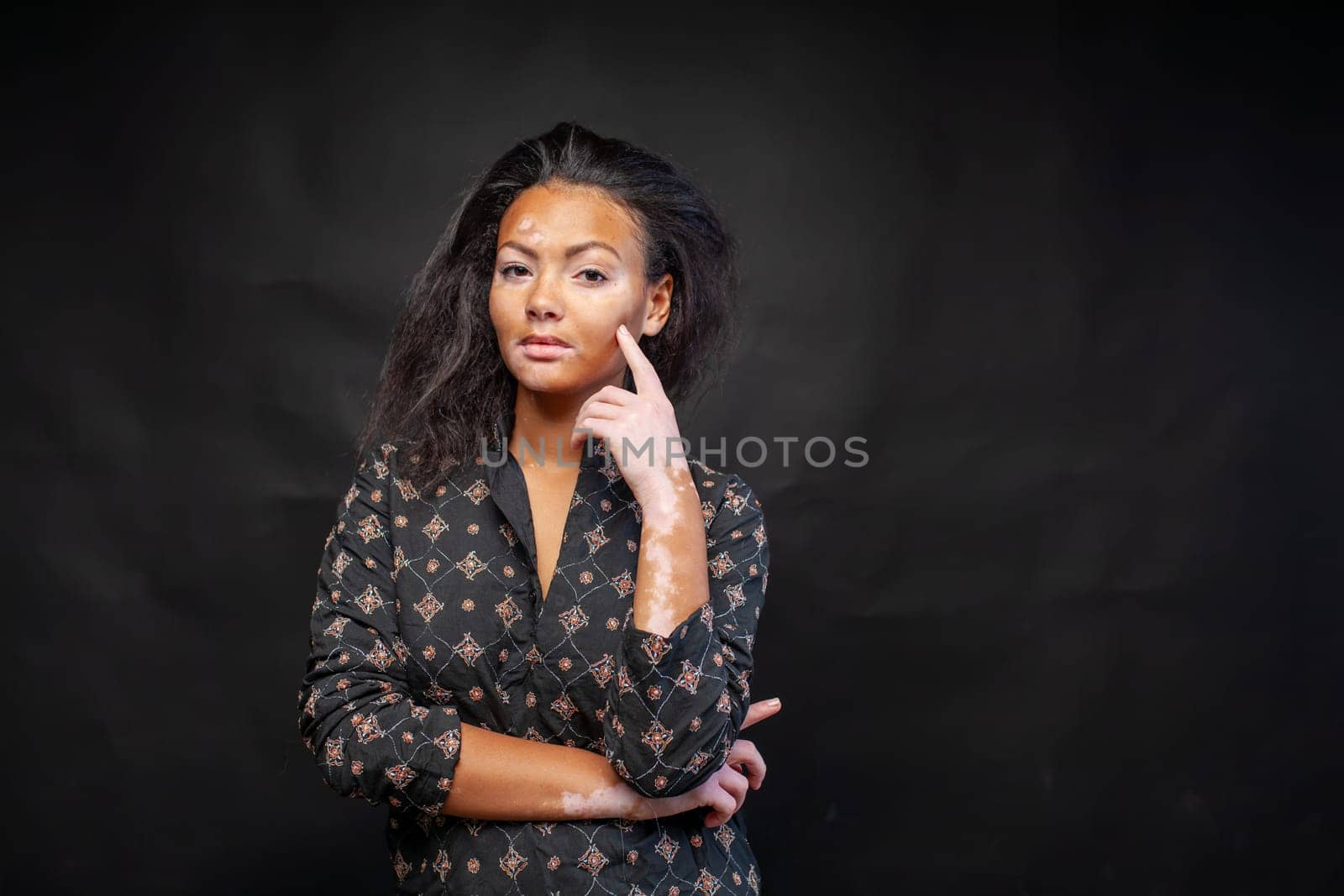 Confident woman with Vitiligo disease standing in black studio by andreonegin