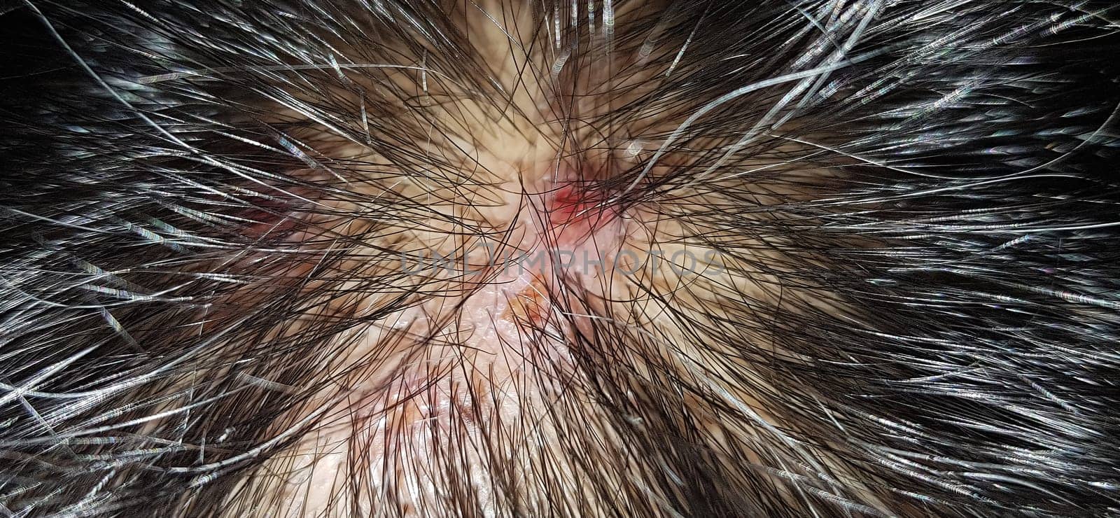 Scabs On The Scalp, wound on the scalps or Lichen planus follicularis capillitii, itch on the scalps, caused by diabetes on adults