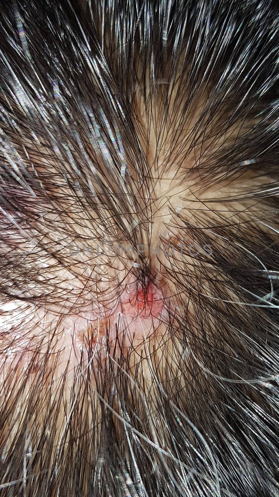 Scabs On The Scalp, wound on the scalps or Lichen planus follicularis capillitii, itch on the scalps, caused by diabetes on adults