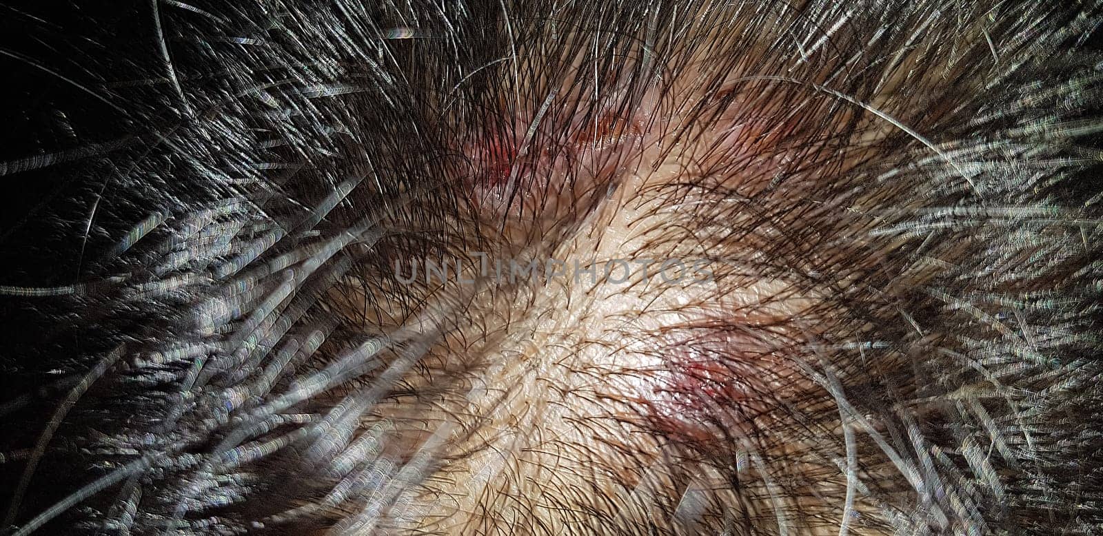 Scabs On The Scalp, wound on the scalps or Lichen planus follicularis capillitii, itch on the scalps, caused by diabetes on adults