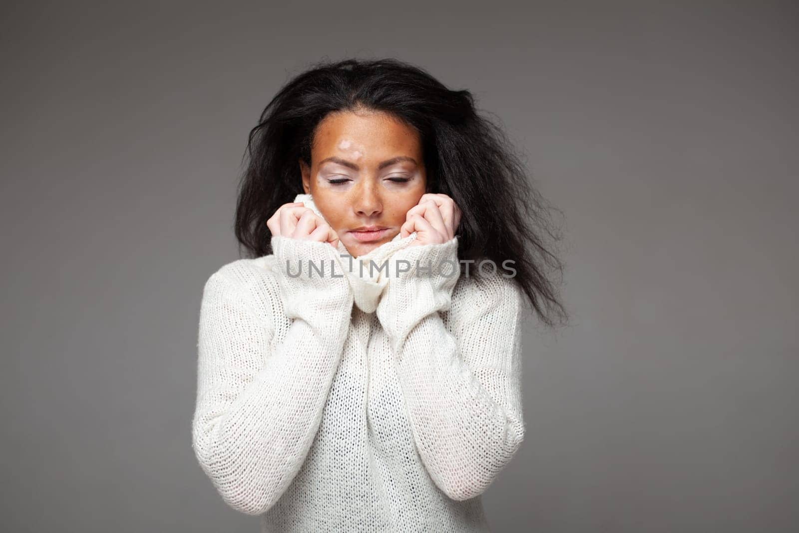 Beautiful African girl with skin problem in white pullover against gray background. Portrait of black woman with Vitiligo disease posing in studio.