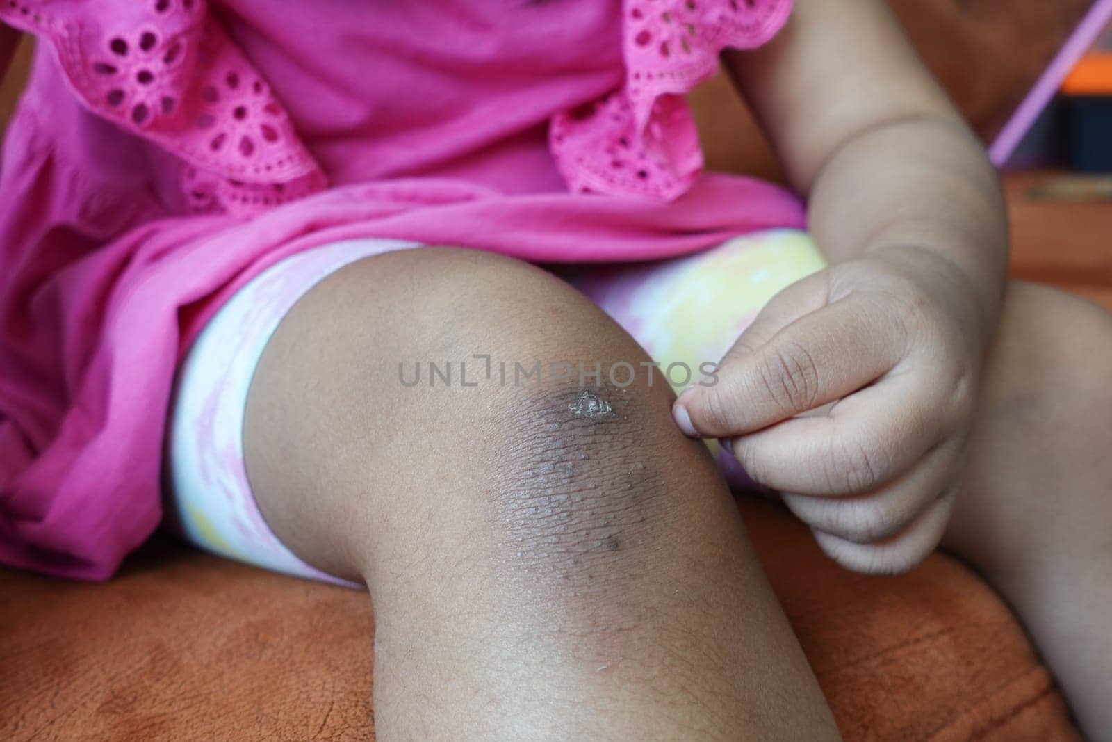 stain bruise wound on child knee
