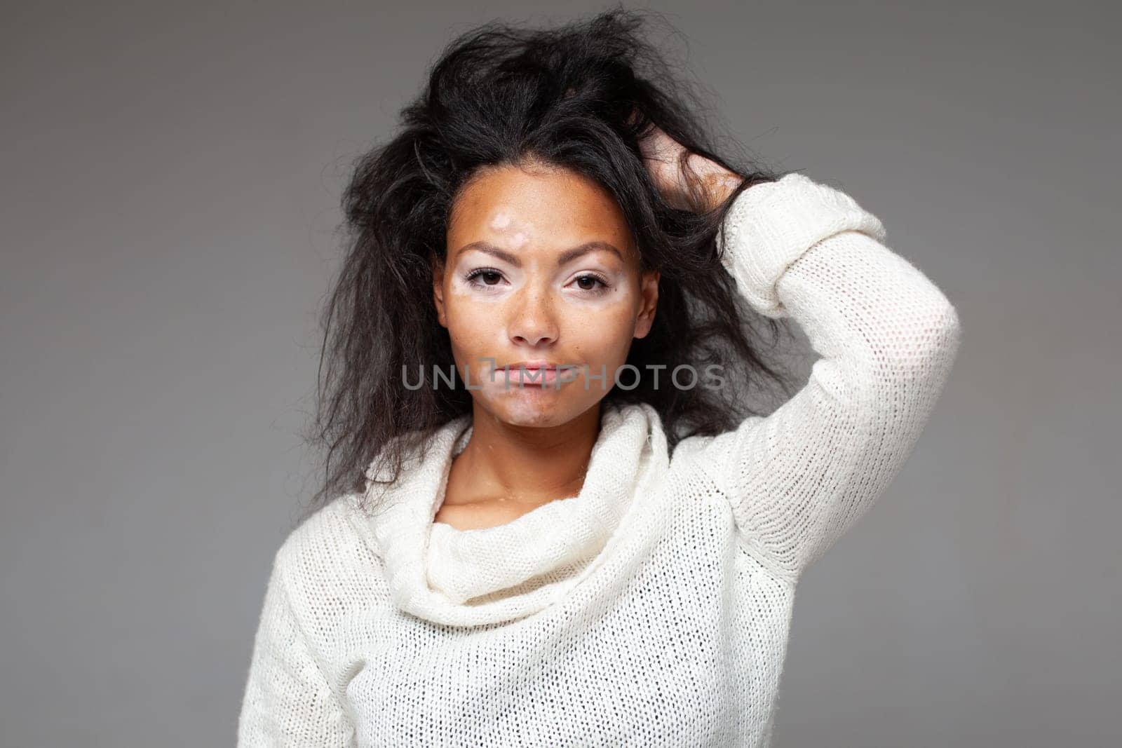 Confident black woman with Vitiligo disease looking at camera. Portrait of African American lady with hand in hair standing against gray background. Girl with pigmentation skin problem.