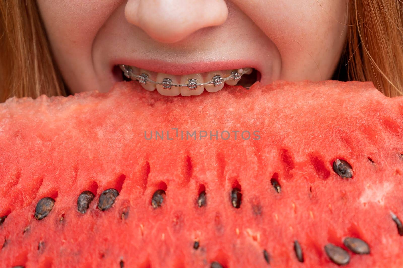 Close-up portrait of red-haired young woman with braces eating watermelon outdoors.