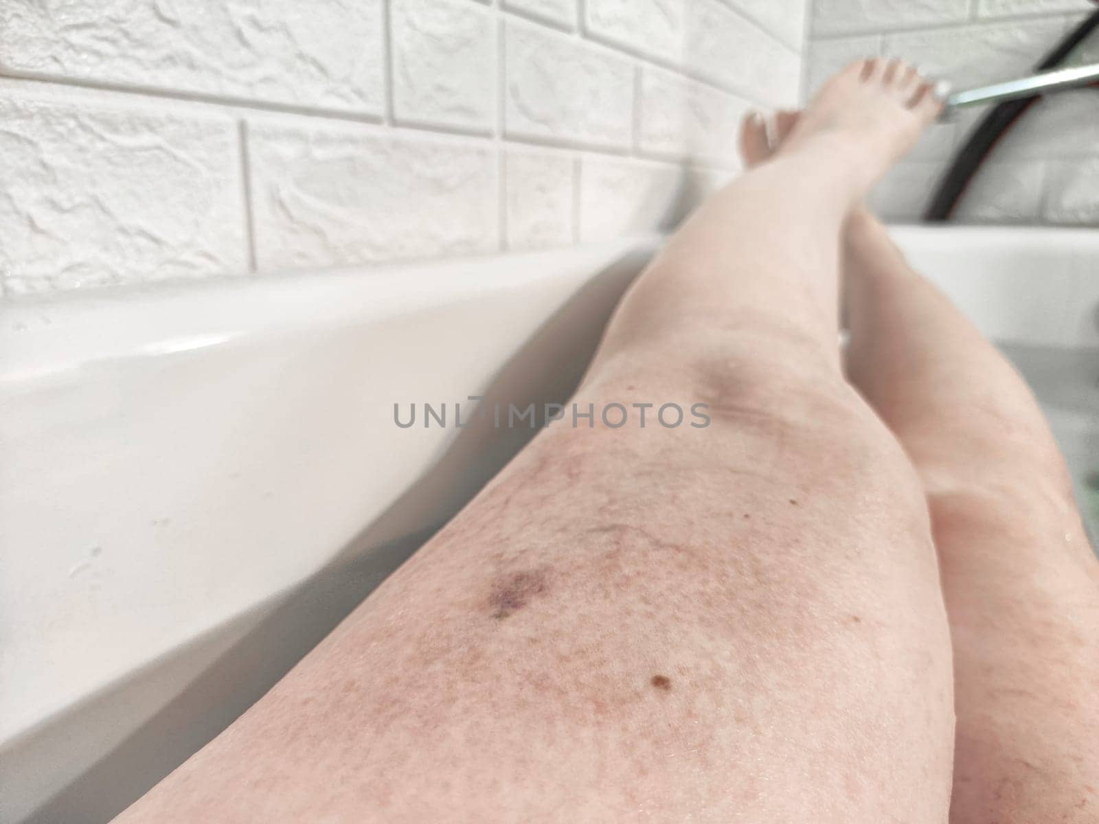 Close-Up of Varicose Veins on a Leg in the Bathtub. Leg with varicose veins while submerged in bathtub, highlighting the health condition