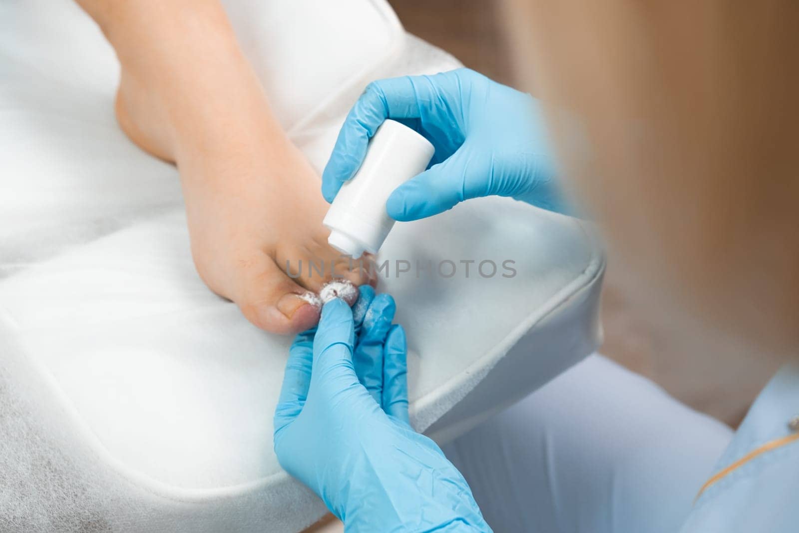 After extracting the nail, the podologist applies a fine antiseptic powder to the toe