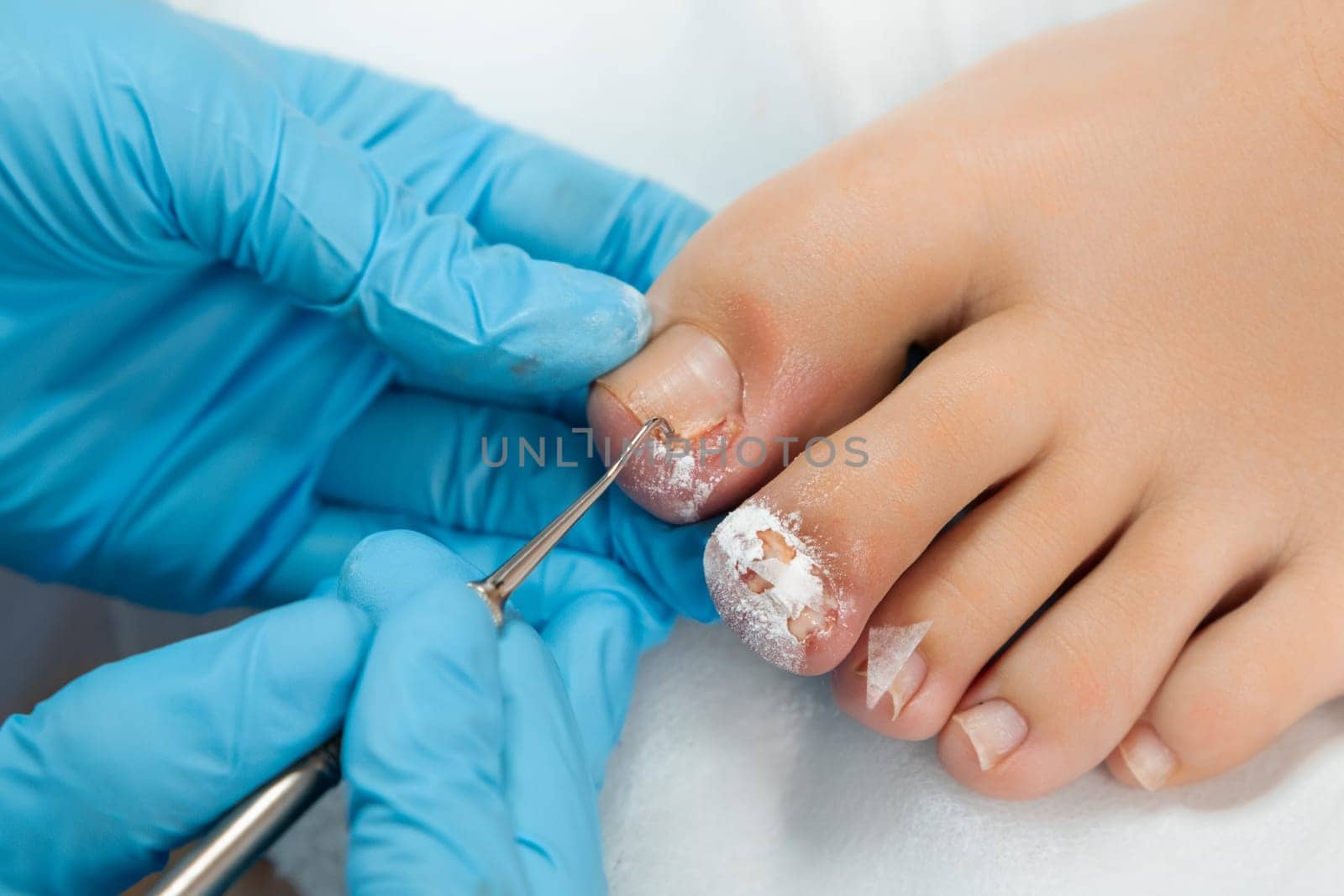 Podologist in blue gloves doing medical treatment on female toes in medical center.