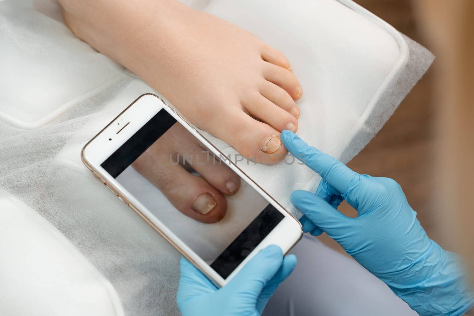 Podologist compares the results after ingrown toenails removal using a photo on a smartphone