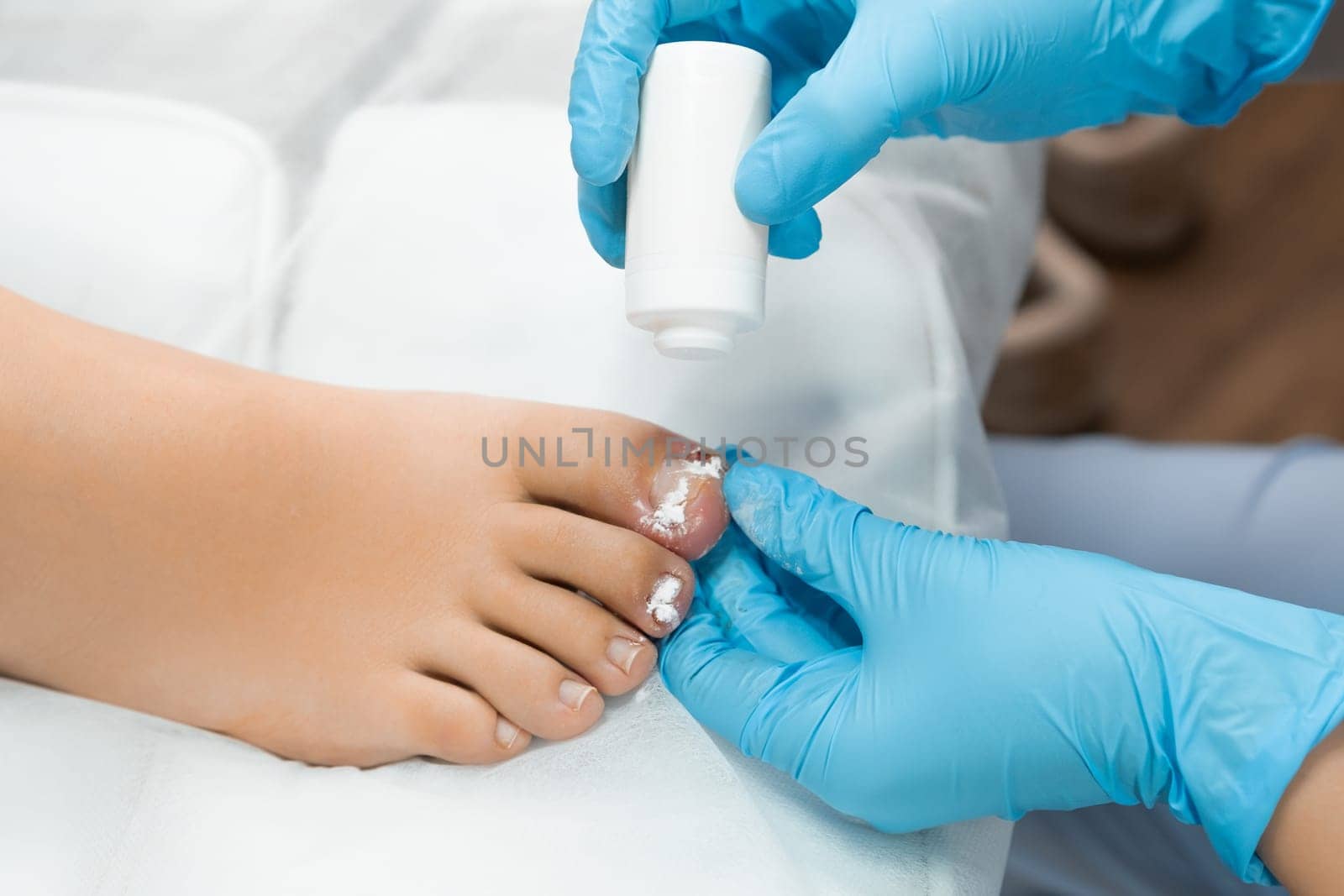 After the nail is removed, the podologist applies a powdery antiseptic to the toe for disinfection