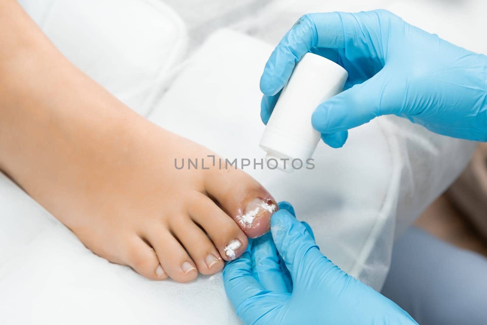 The foot specialist administers a dusty disinfectant to the toe following the extraction of the nail by vladimka