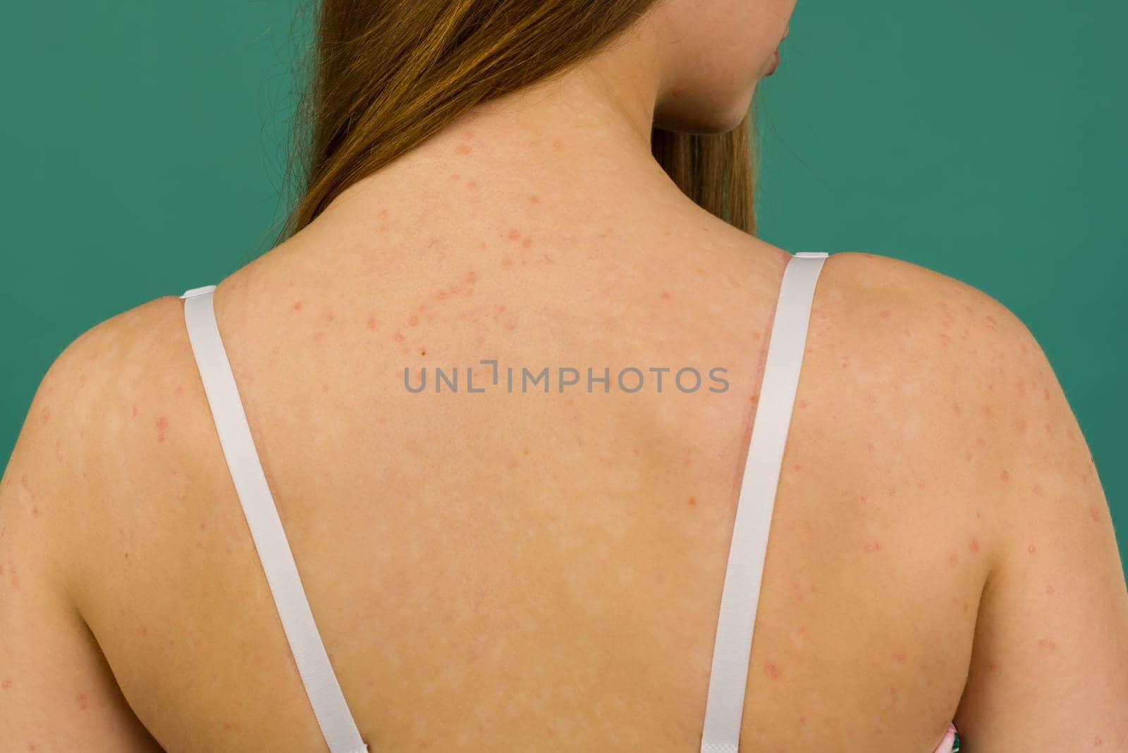 CLOSE UP: Unrecognizable young woman suffering from autoimmune incurable dermatological skin disease called psoriasis. Red, inflamed, scaly rash on elbows. Psoriatic arthritis