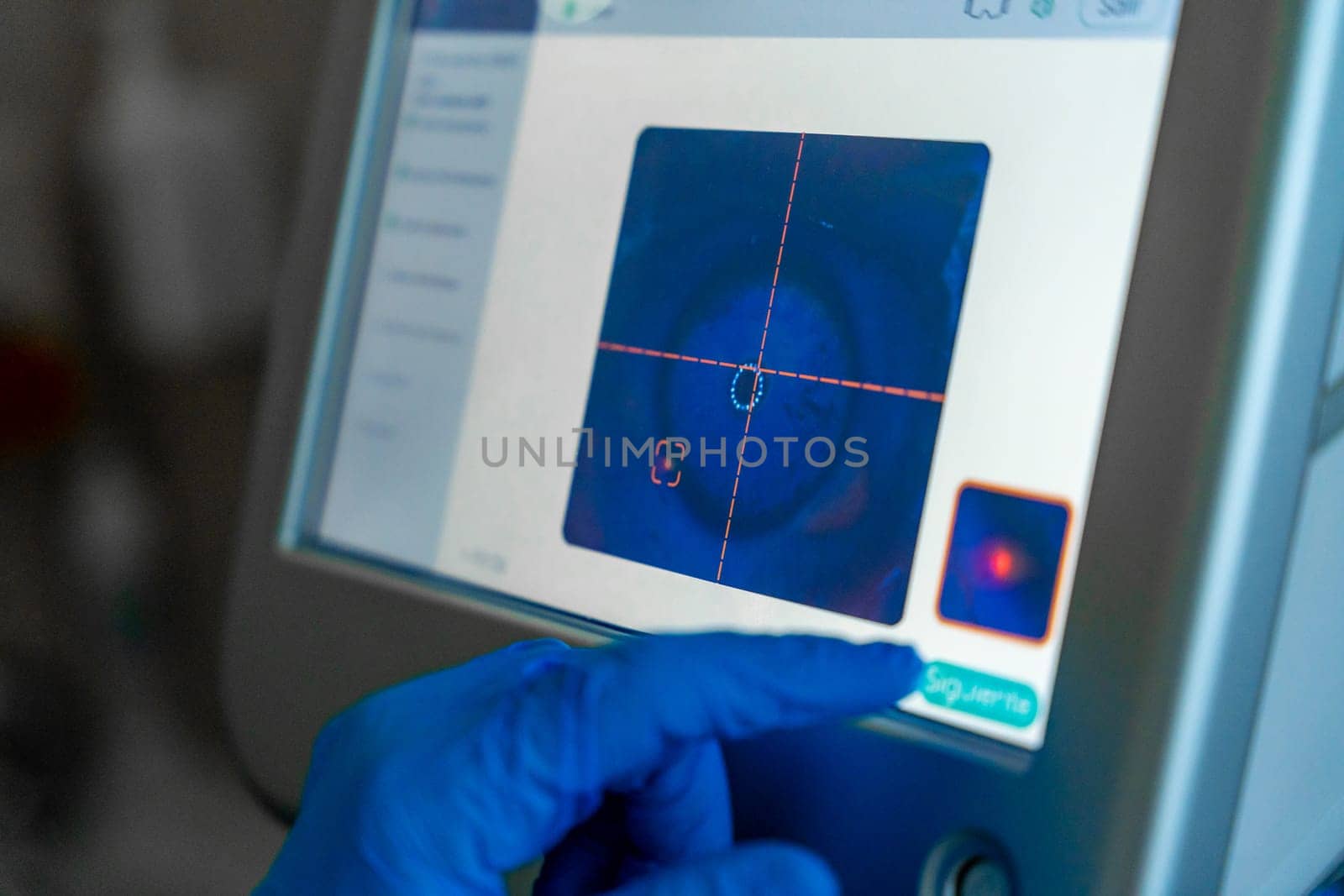 Screen used by the ophthalmologist to monitor the eye for laser application during glaucoma treatment in a patient
