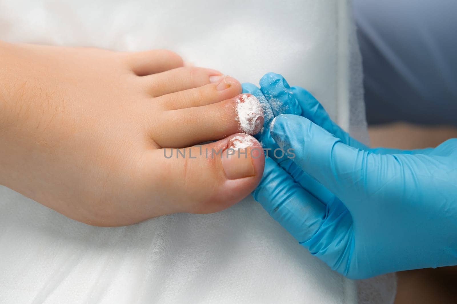 The toe receives a dusting of antiseptic powder from the podologist after nail removal