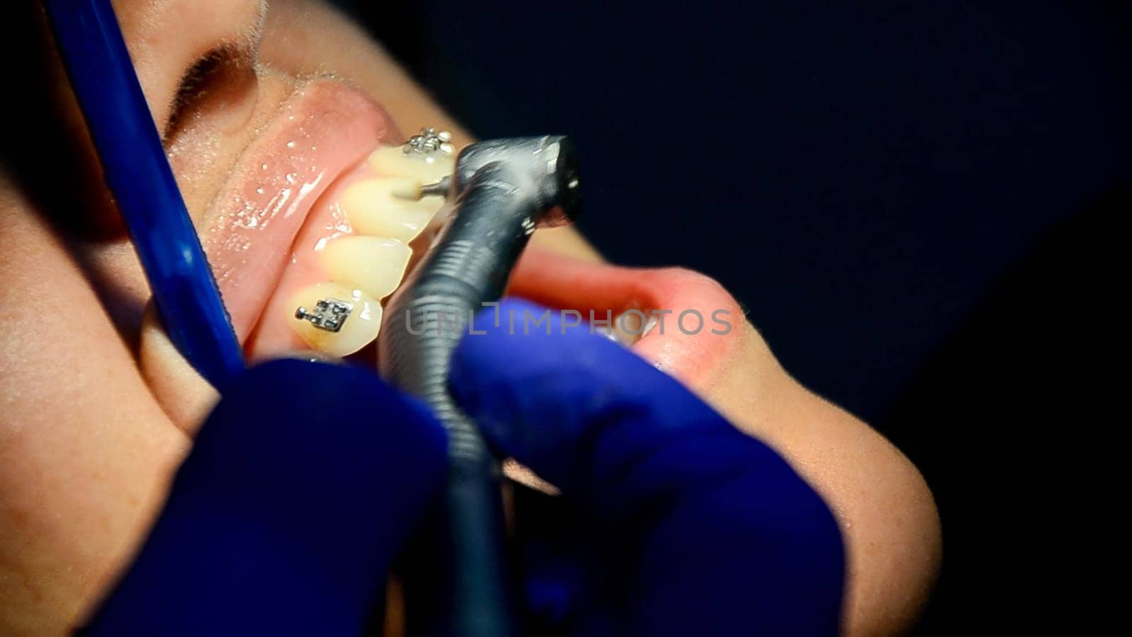 Close-up of a patient undergoing dental braces adjustment with special tools