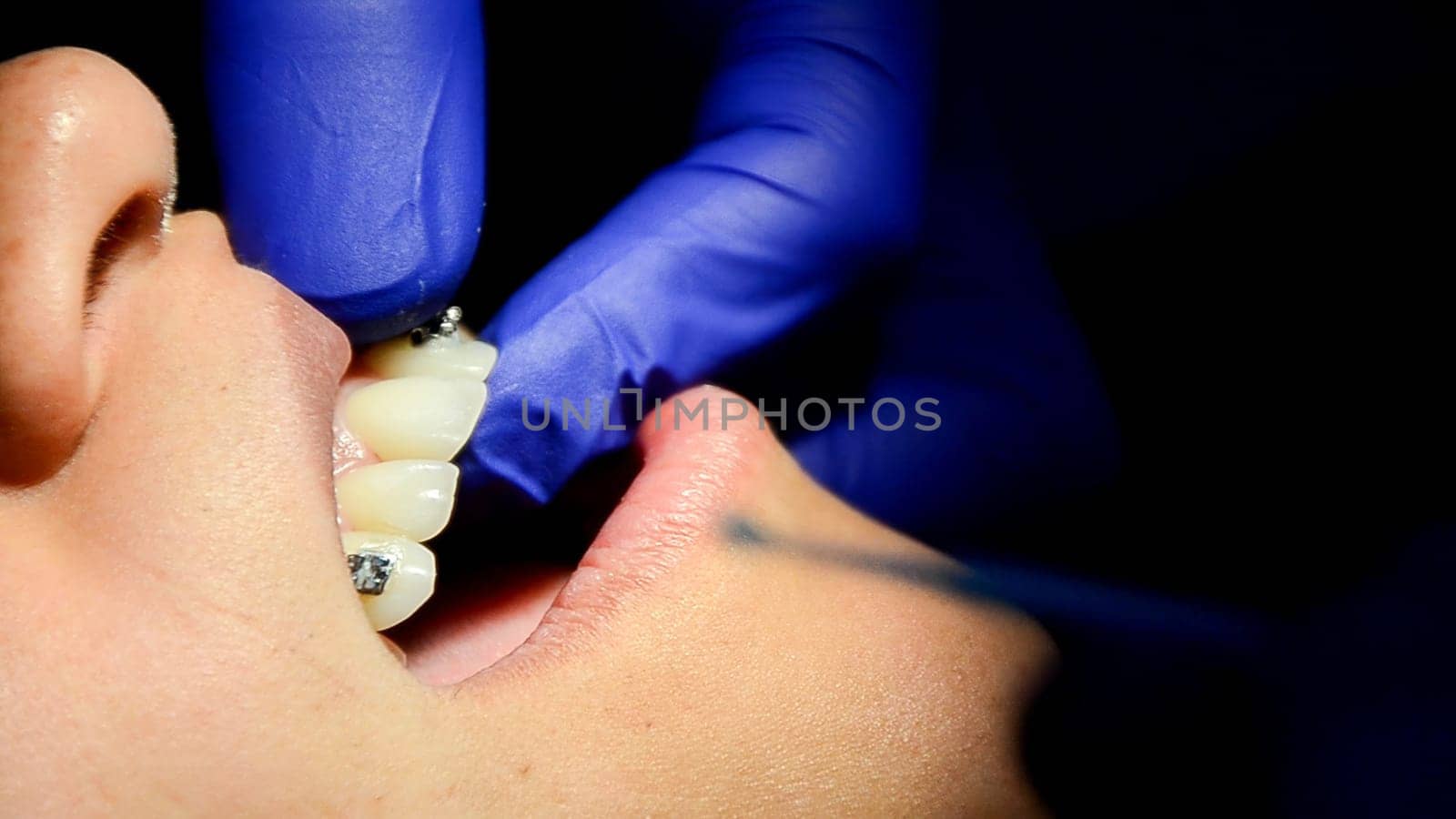 Dental shade matching procedure close-up by Peruphotoart
