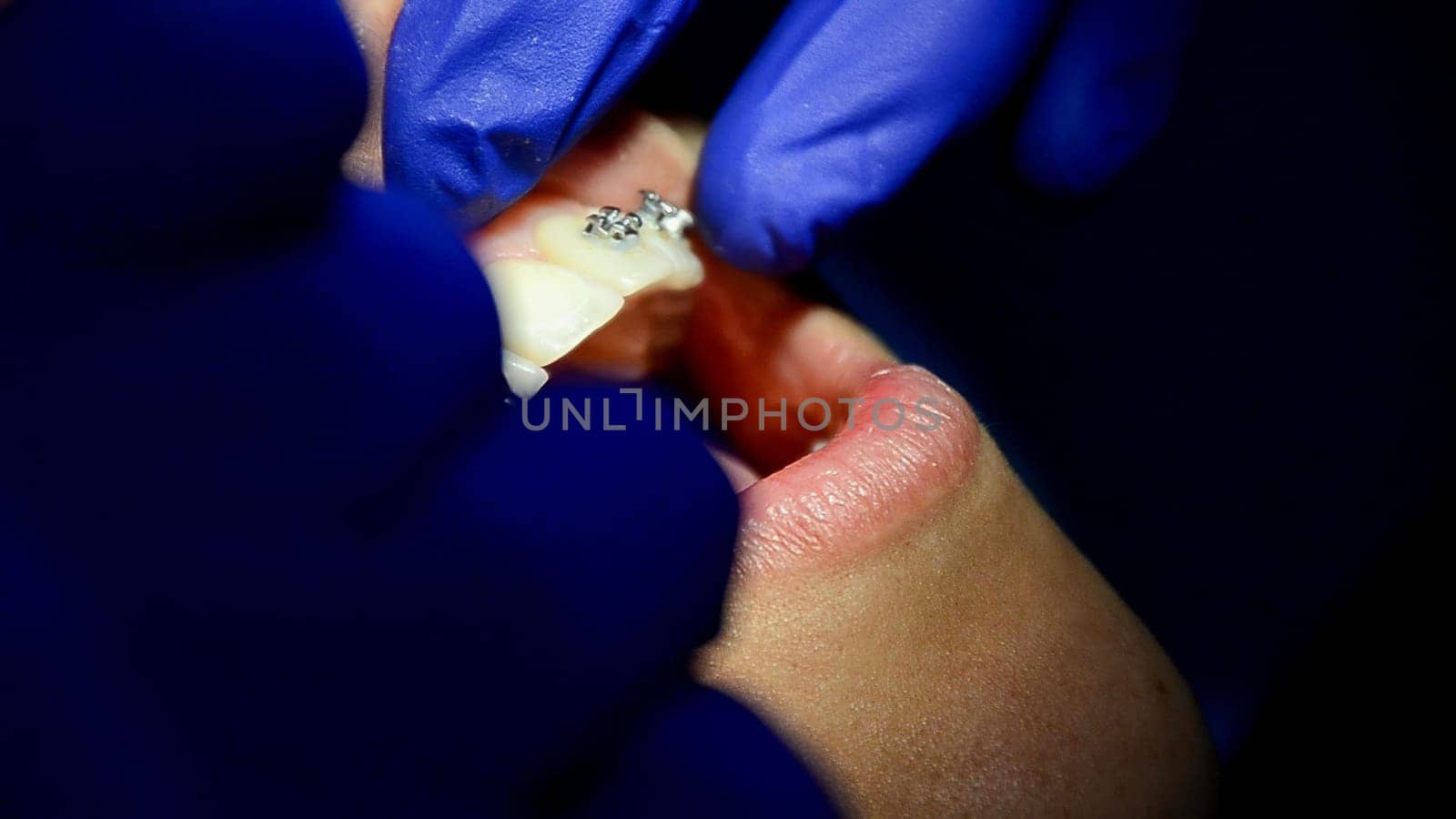 Close-up shot of a dentist's hands adjusting dental braces on patient