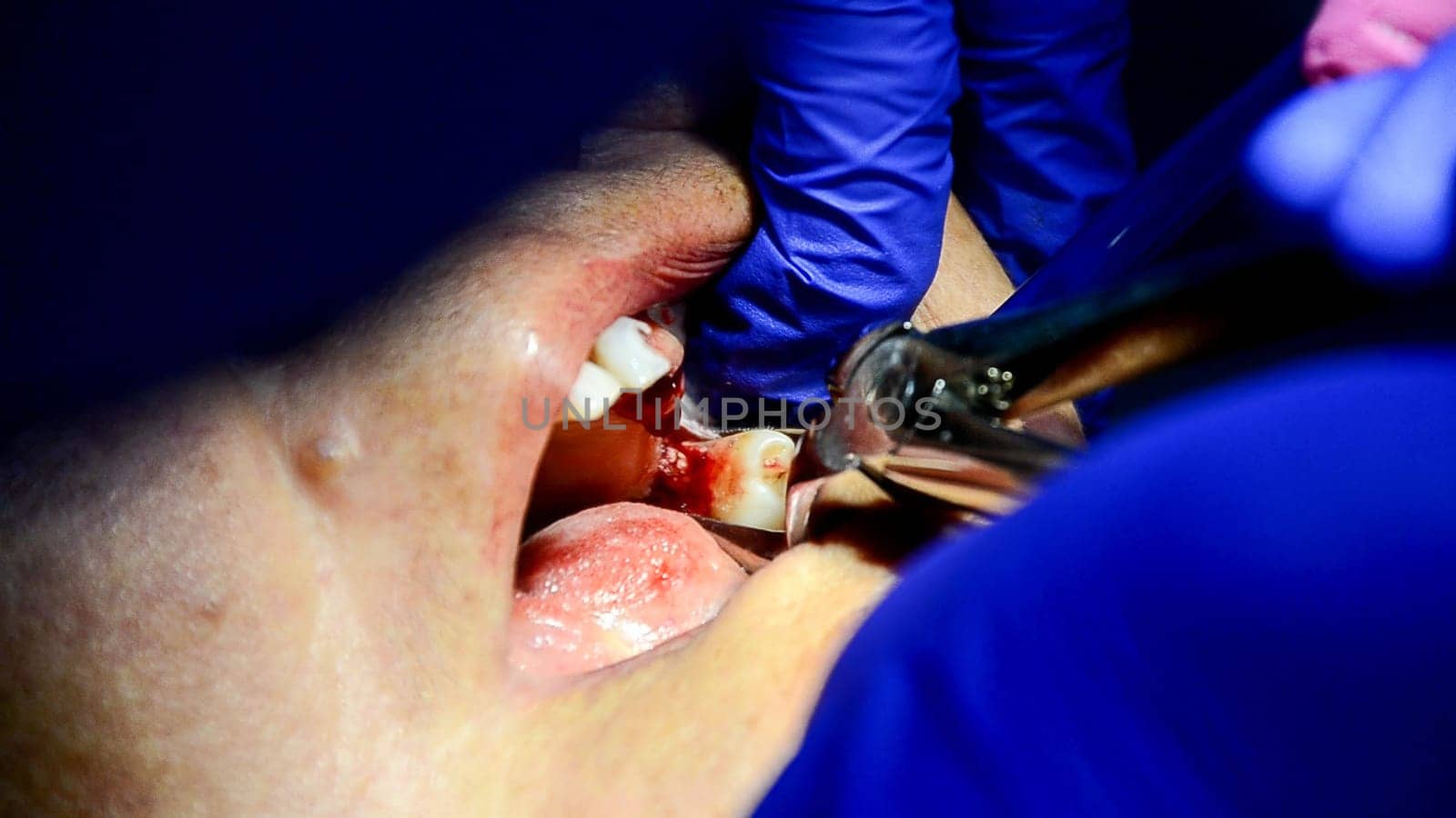 A close-up view of a dental operation, with tools in use by Peruphotoart
