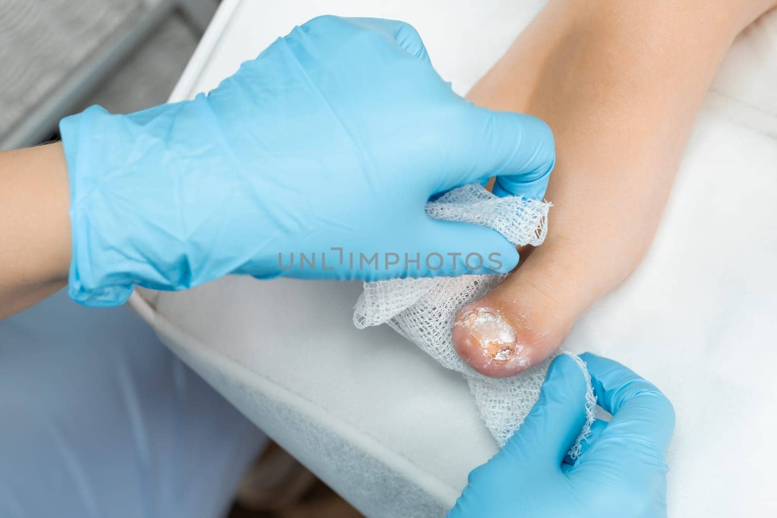 Podologist applies a powdery antiseptic to the toe after removing the nail.