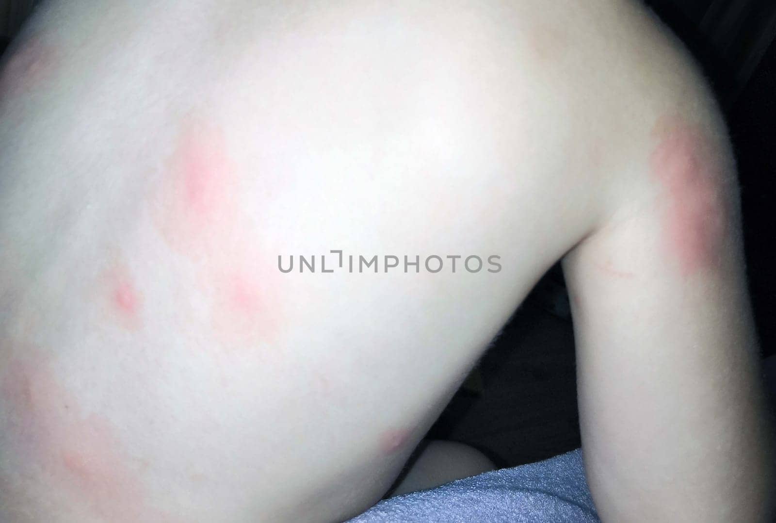A shirtless child with red bite marks on his back. High quality photo