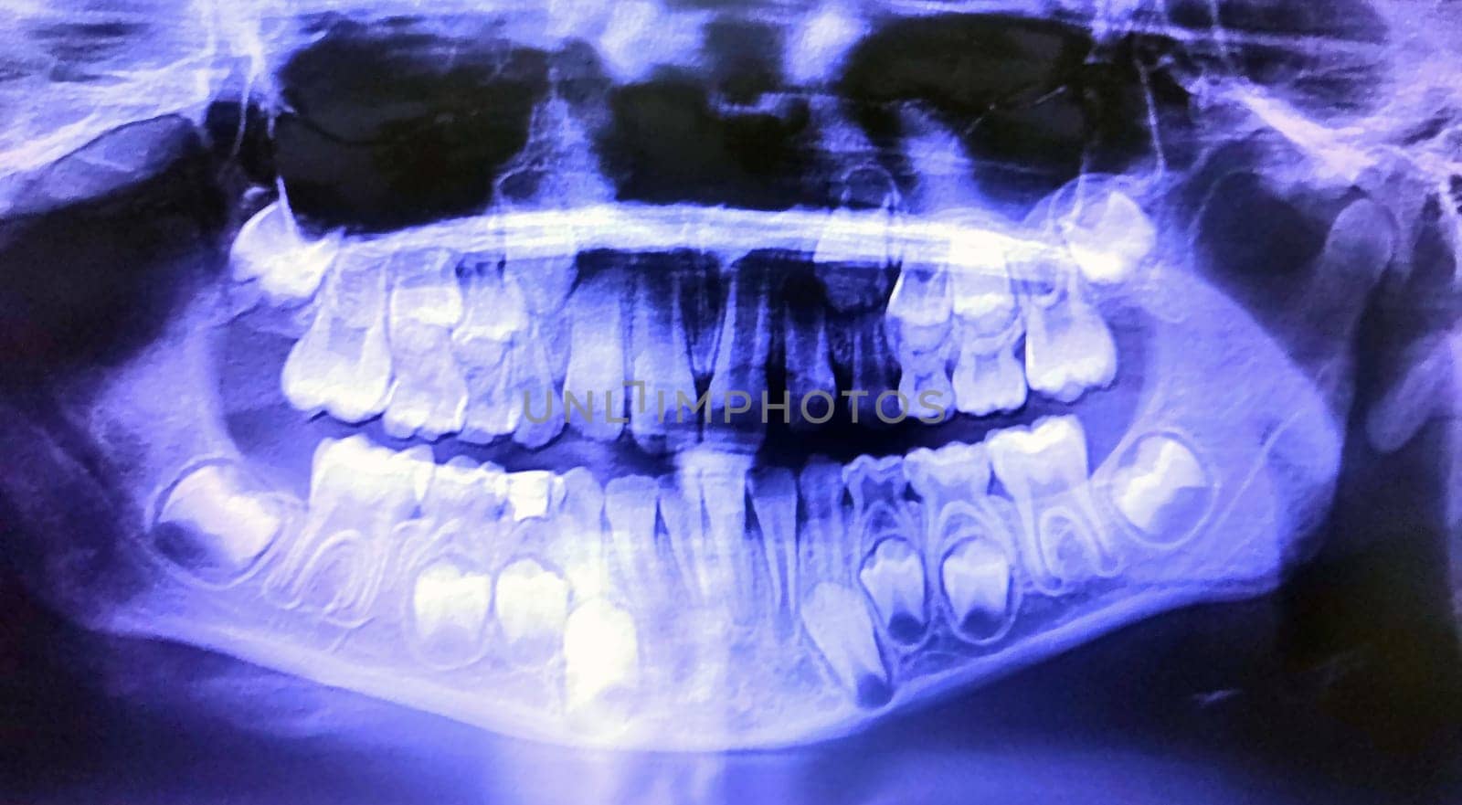 This x-ray displays a detailed view of a human skull with teeth visible. The teeth are well-defined within the jawbone, showcasing the structure of the dental arch and individual teeth.