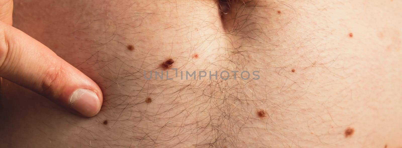 Unrecognizable man showing his birthmarks on skin Close up detail of the bare skin Sun Exposure effect on skin. Health Effects of UV Radiation Male with birthmarks Pigmentation by anna_stasiia