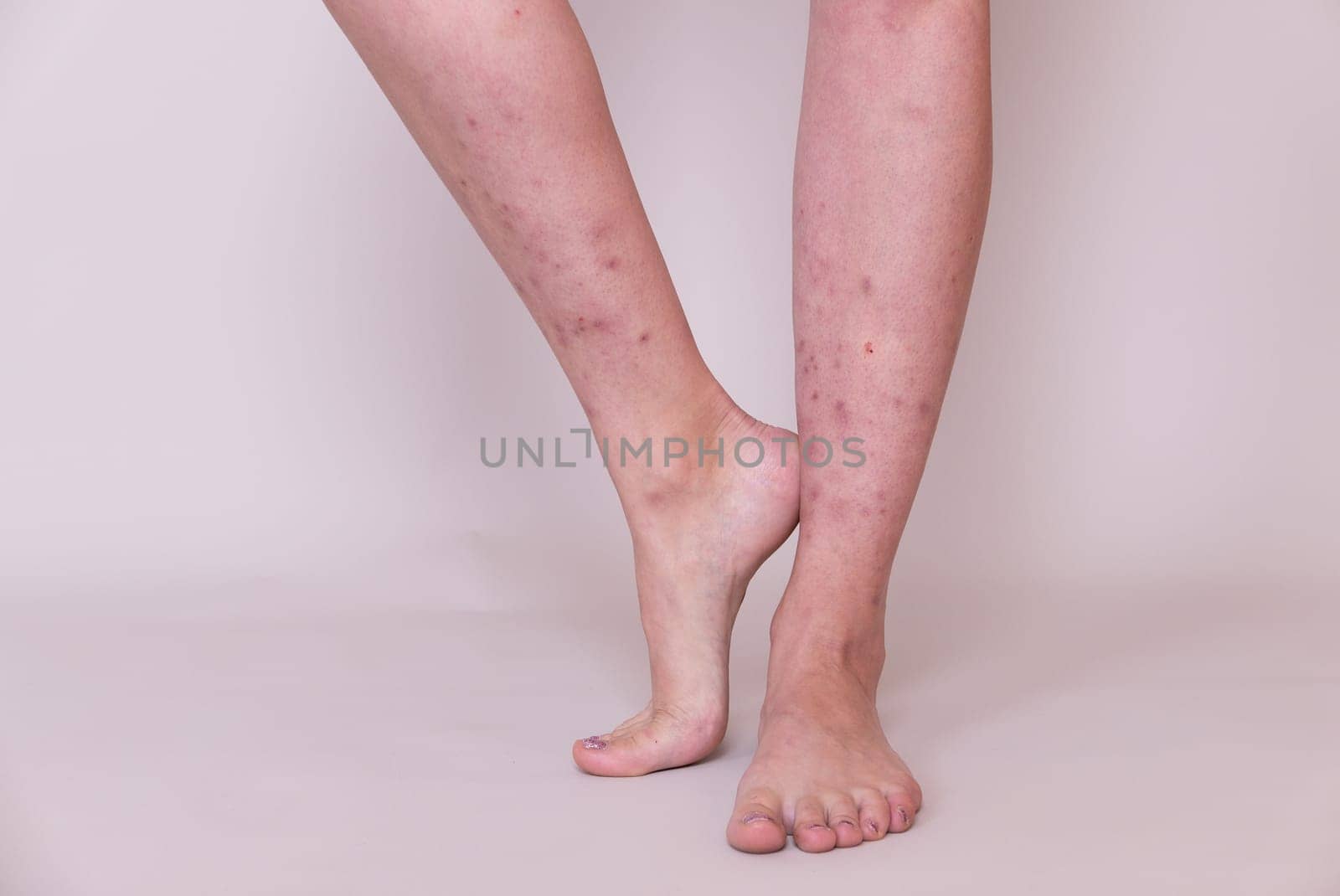 Female legs with many red spot and scar, insect bites on legs by zartarn