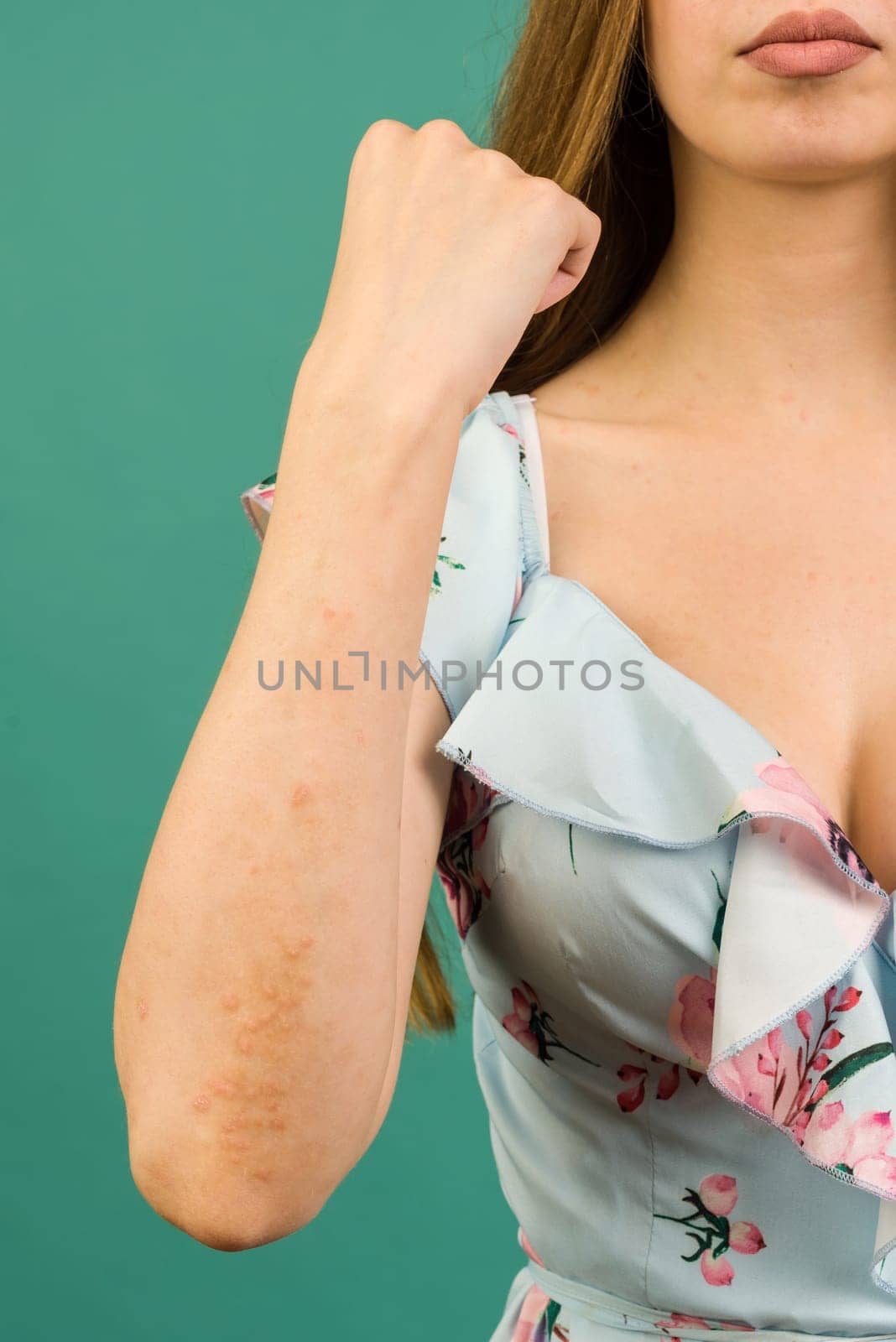 CLOSE UP: Unrecognizable young woman suffering from autoimmune incurable dermatological skin disease called psoriasis. by zartarn