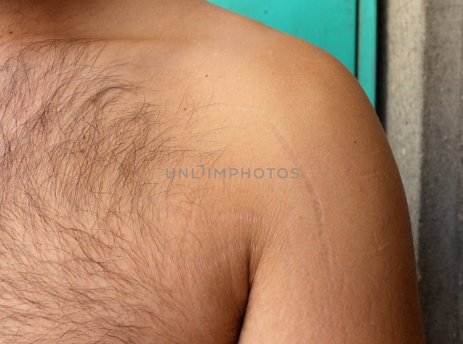 self-acceptance and care as you explore the topic of stretch marks on a man's arms and chest