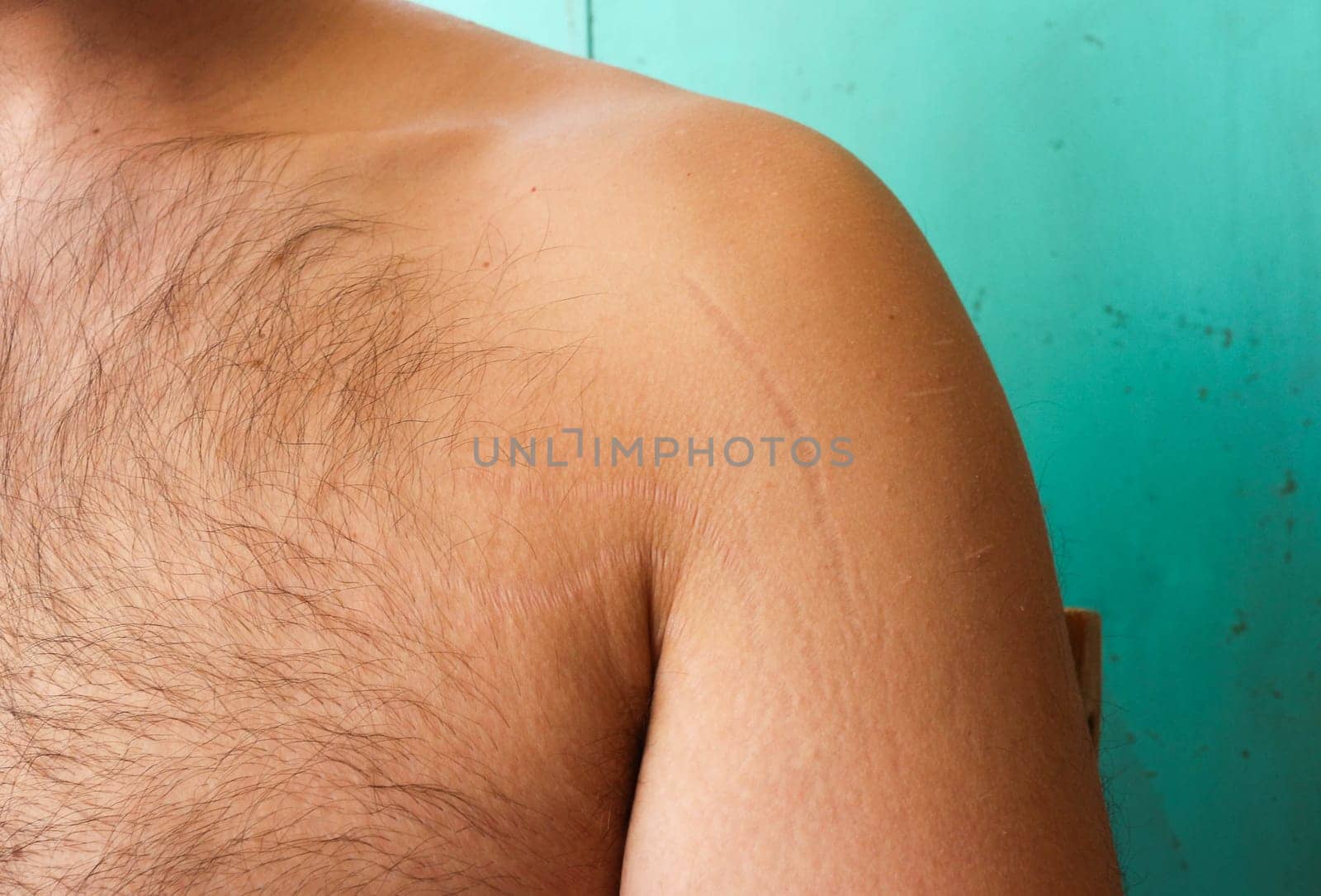 Embracing Change: Understanding and Treating Stretch Marks on Male Arms and Chest by DakotaBOldeman